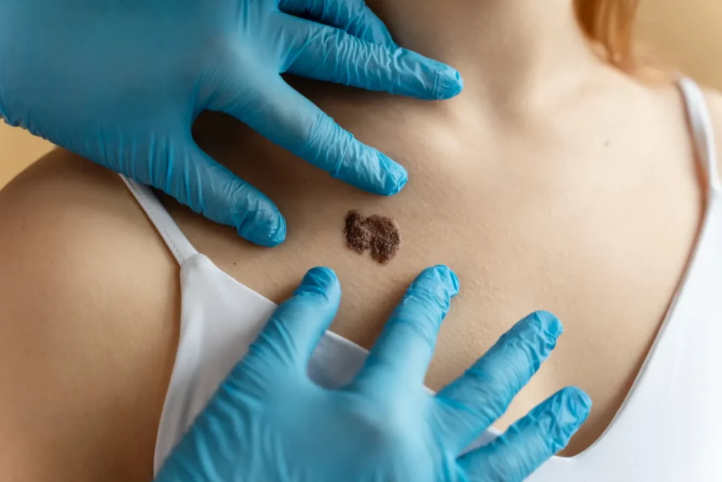 Maestría en Complicaciones Cutáneas por Estética Necrosis Granulomas e Infecciones 3
