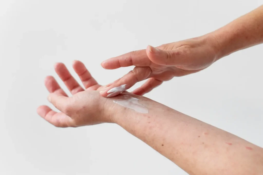 Maestría en Dermatitis Atópica y de Contacto y su Impacto Estético 3