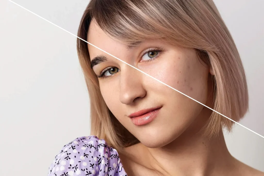 Maestría en Hiperpigmentaciones Melasma PIH y Tratamientos Combinados 2