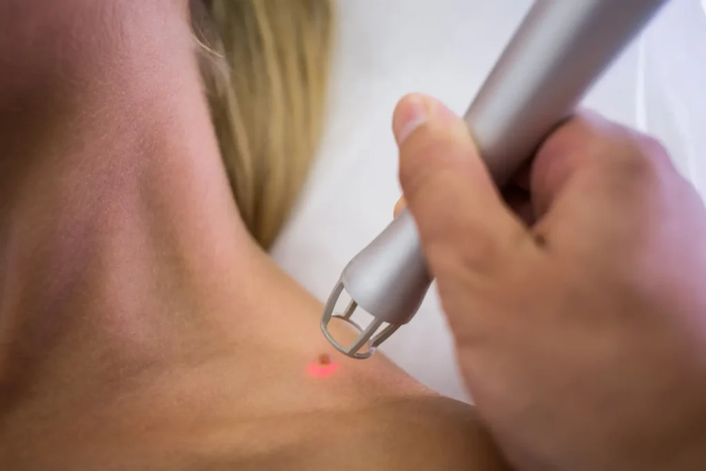 Máster en Láser Dermatológico para Patología y Estética Vasculares y Pigmento 3